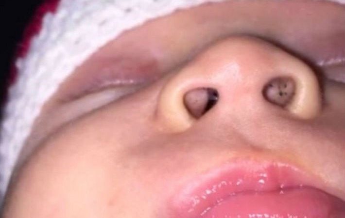 Майката забелязала малки черни точки в носа на бебето – внимавайте, защото е много ОПАСНО! img