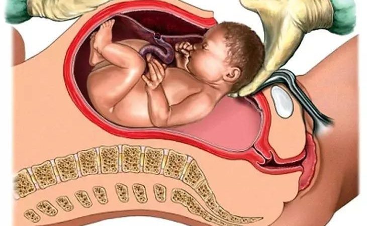 5 мита за децата, родени с цезарово сечение, в които всички вярват, но дали е вярно? img