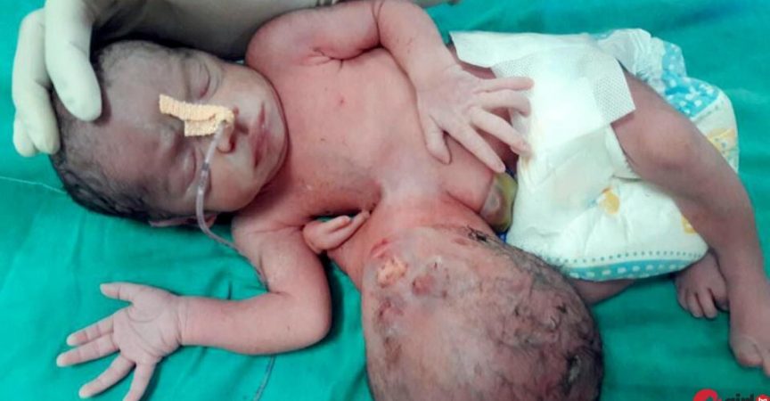 Уникален феномен: В Индия се роди дете с 3 ръце и 2 глави (снимка) img