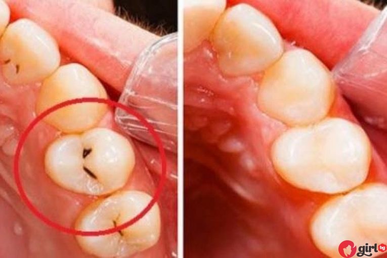 как да възстановим зъбите си