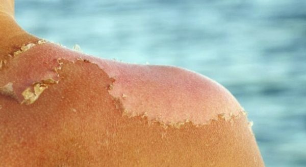 Какво да направите, когато кожата ви започне да се бели след слънчево изгаряне
